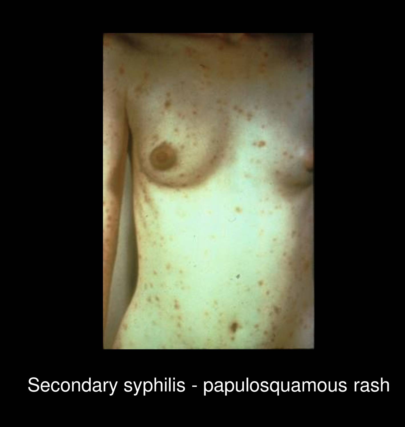 Syphilitic alopecia showing moth-eaten pattern of hair loss on scalp caused by Treponema pallidum infection in secondary stage